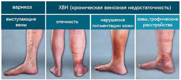 Етапи на разширени вени