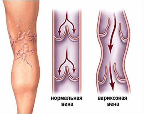 Различни вени