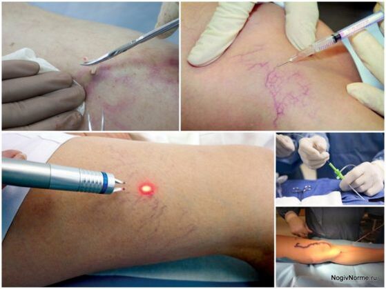 Видове лечение