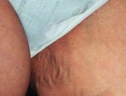 Разширени вени на малкия таз